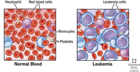 Leukemia Blood Cell Counts for Diagnosis, Treatment, and Follow.